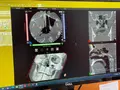 Компьютерный томограф NewTom Giano HR Advanced 13x16 с цефалостатом